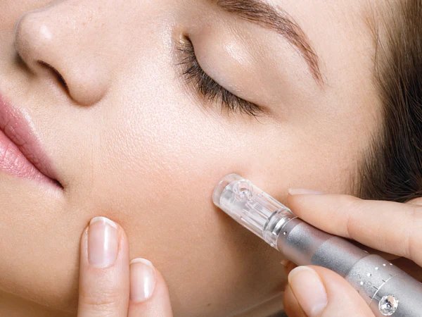 Microneedling treatment — a fine needling pen gliding over smooth skin
